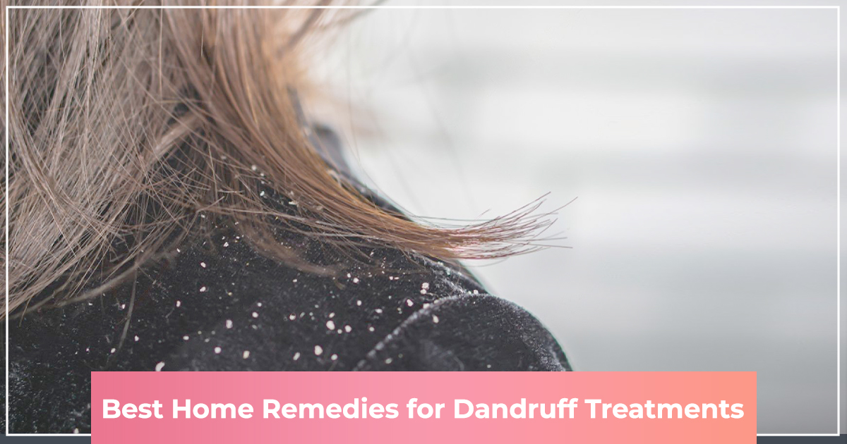 10 Best Home Remedies for Dandruff Treatments
